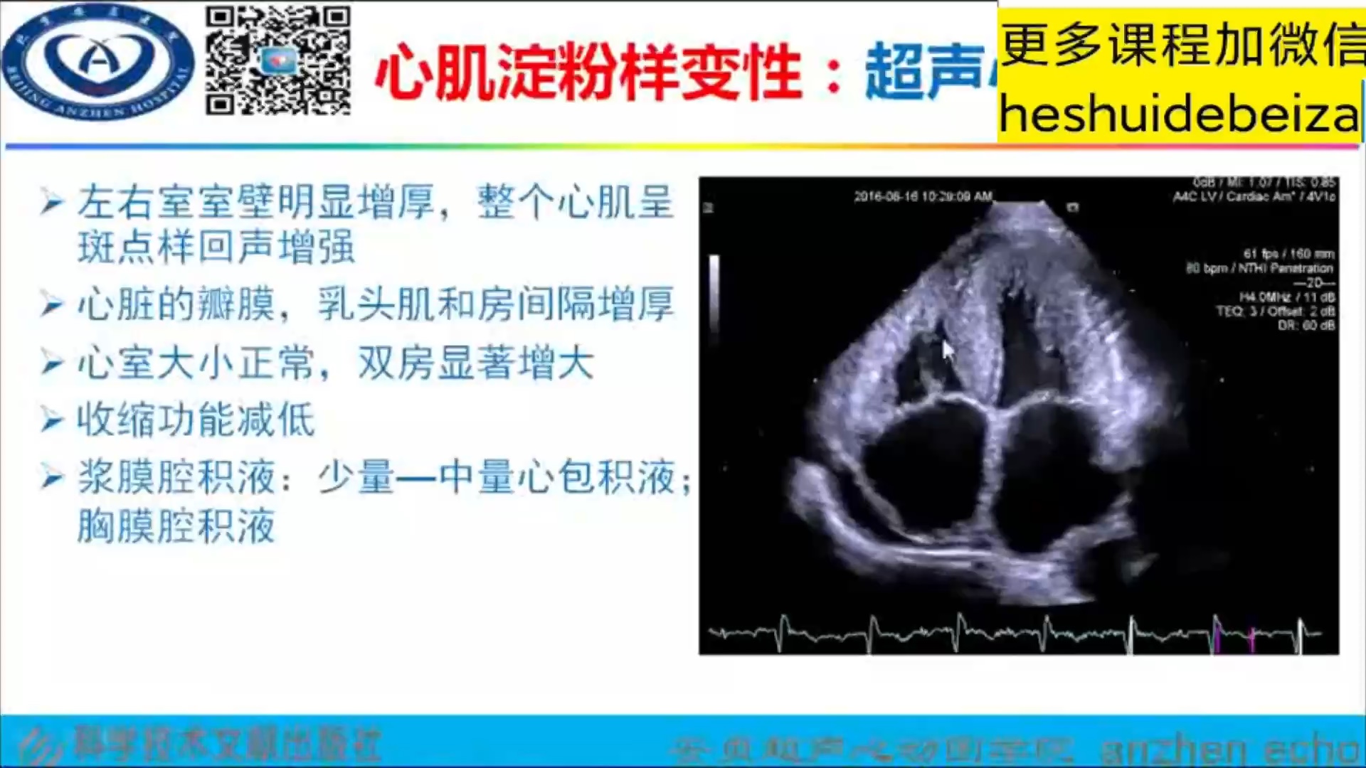 心肌淀粉样变性:病因、病理,特征性超声表现哔哩哔哩bilibili