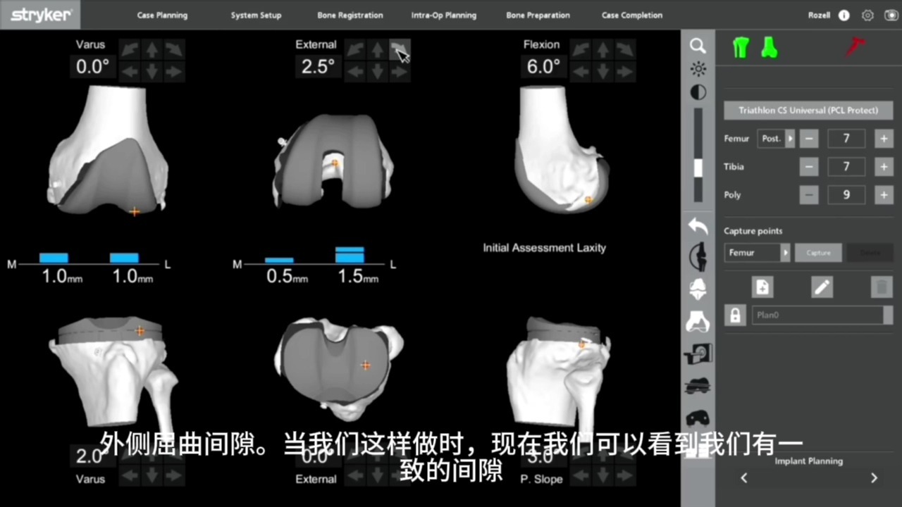 mako 机器人 "精准操刀":全膝关节置换术