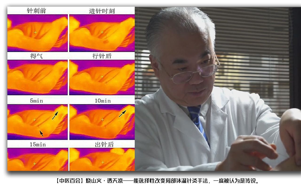 烧山火ⷩ€天凉——能选择性改变局部体温针灸手法,一度被认为是传说.哔哩哔哩bilibili