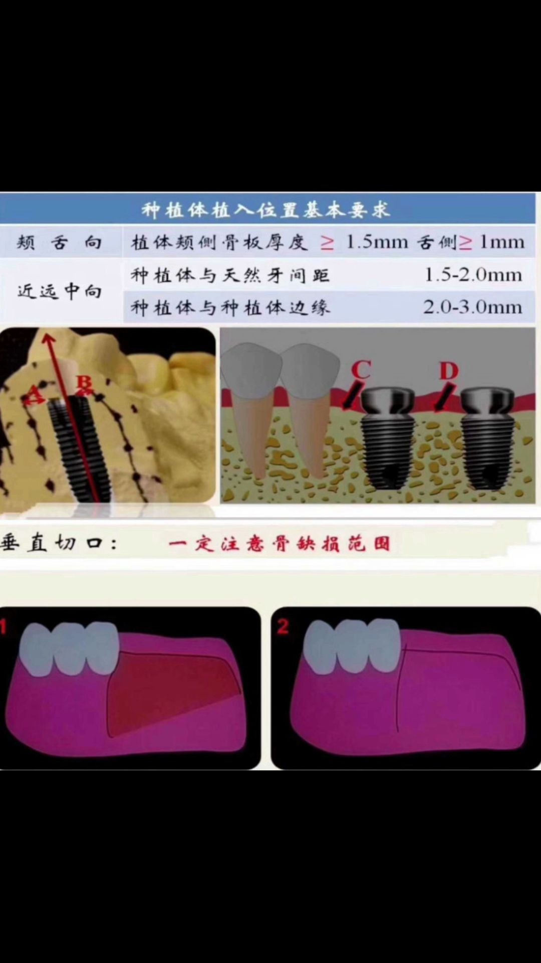 牙医 拔牙 技术经验 汉尔思 口腔培训 技术视频 洲洋牙科组织系统哔哩哔哩bilibili