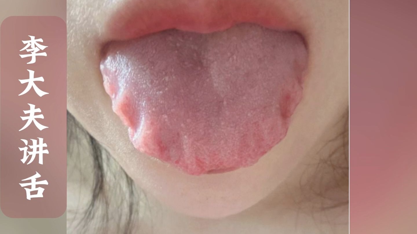 像这种齿痕舌,可不止是湿气,真正的根源在气虚!