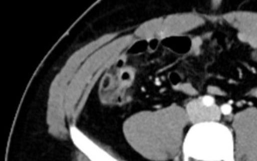 20220329肠脂垂炎(Epiploic appendagitis)哔哩哔哩bilibili