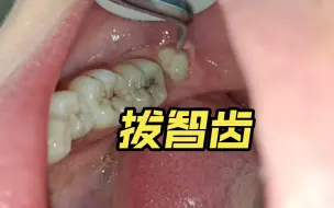 Descargar video: 智齿露个小脑袋