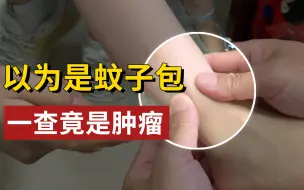 Download Video: 脚肿家长以为是蚊子包，一查竟是骨肿瘤，拍片后发现：骨头都被顶弯了