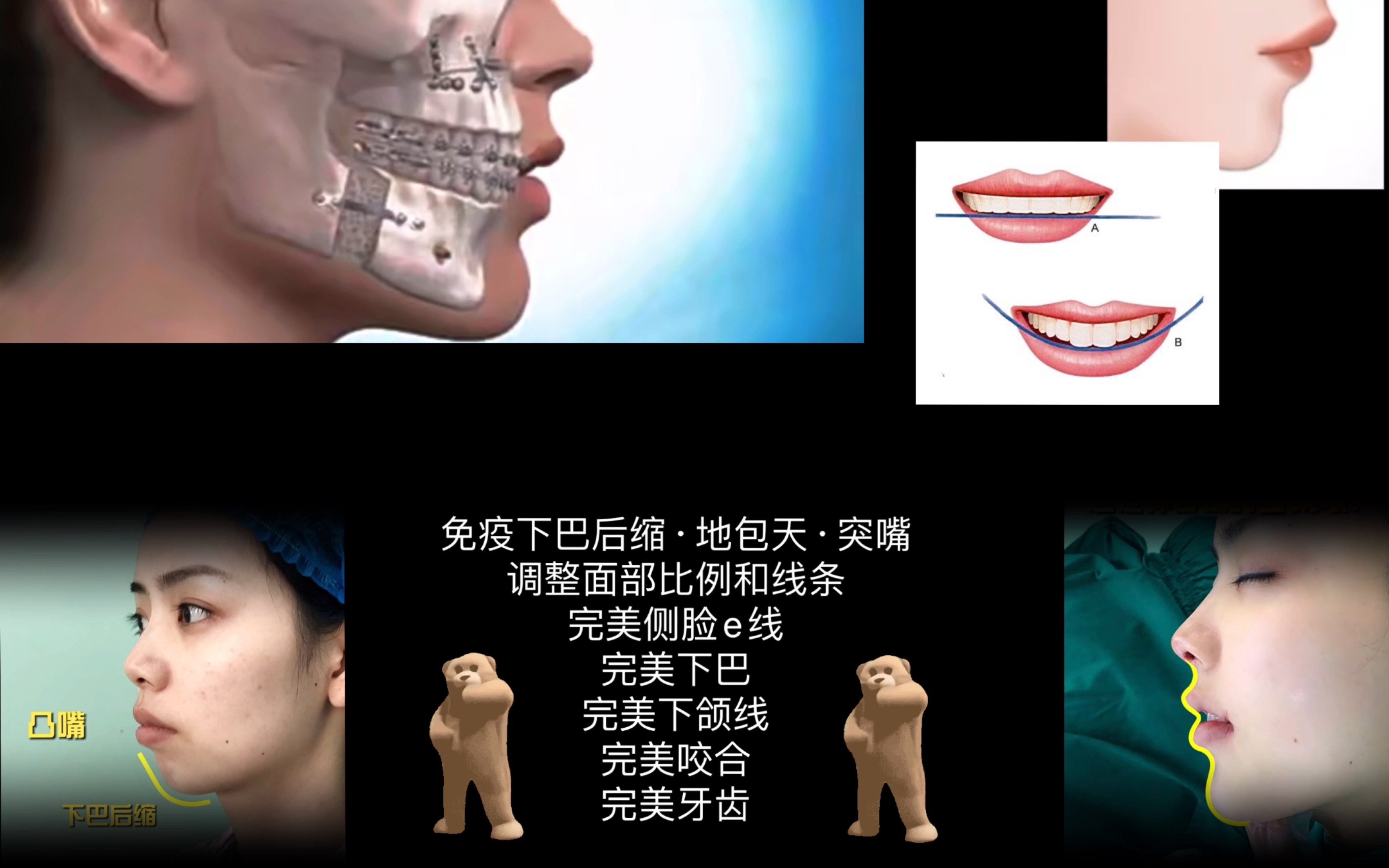 {自制sub} 正颌手术|矫正下巴后缩嘴凸|完美颌面|完美牙齿