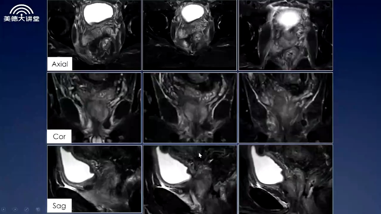前列腺磁共振正常图像图片