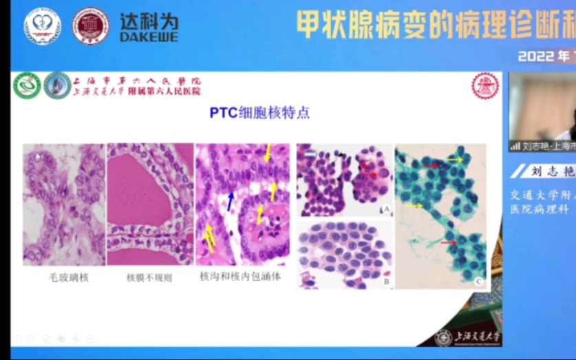 病理诊断甲状腺部分课程录播哔哩哔哩bilibili