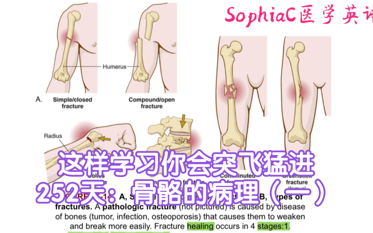 医学英语|这样学习你会突飞猛进系列,252天:骨骼的病理(一).the language of medicine 系列哔哩哔哩bilibili