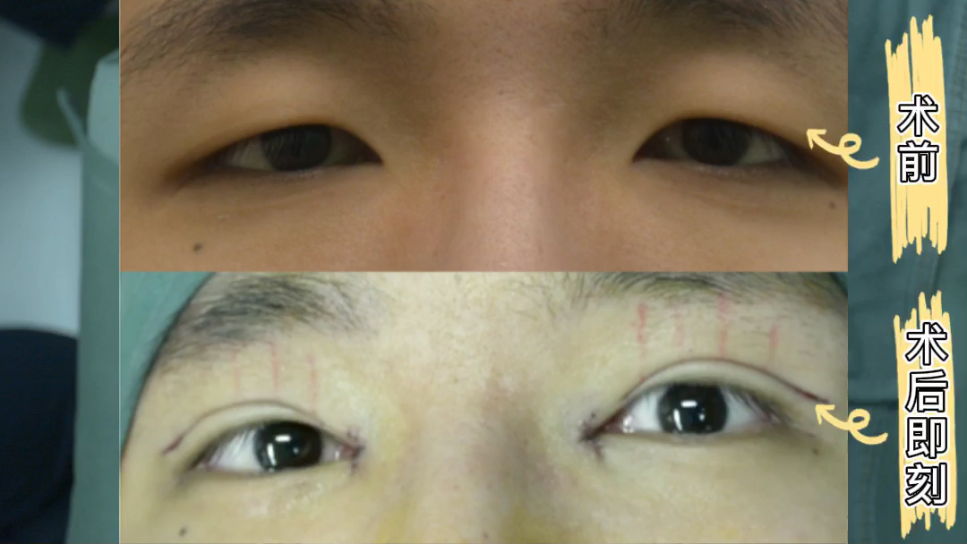 解进医生男生眼尾下垂该怎样矫正