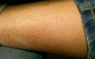 斑色鱼鳞癣 哔哩哔哩 Bilibili