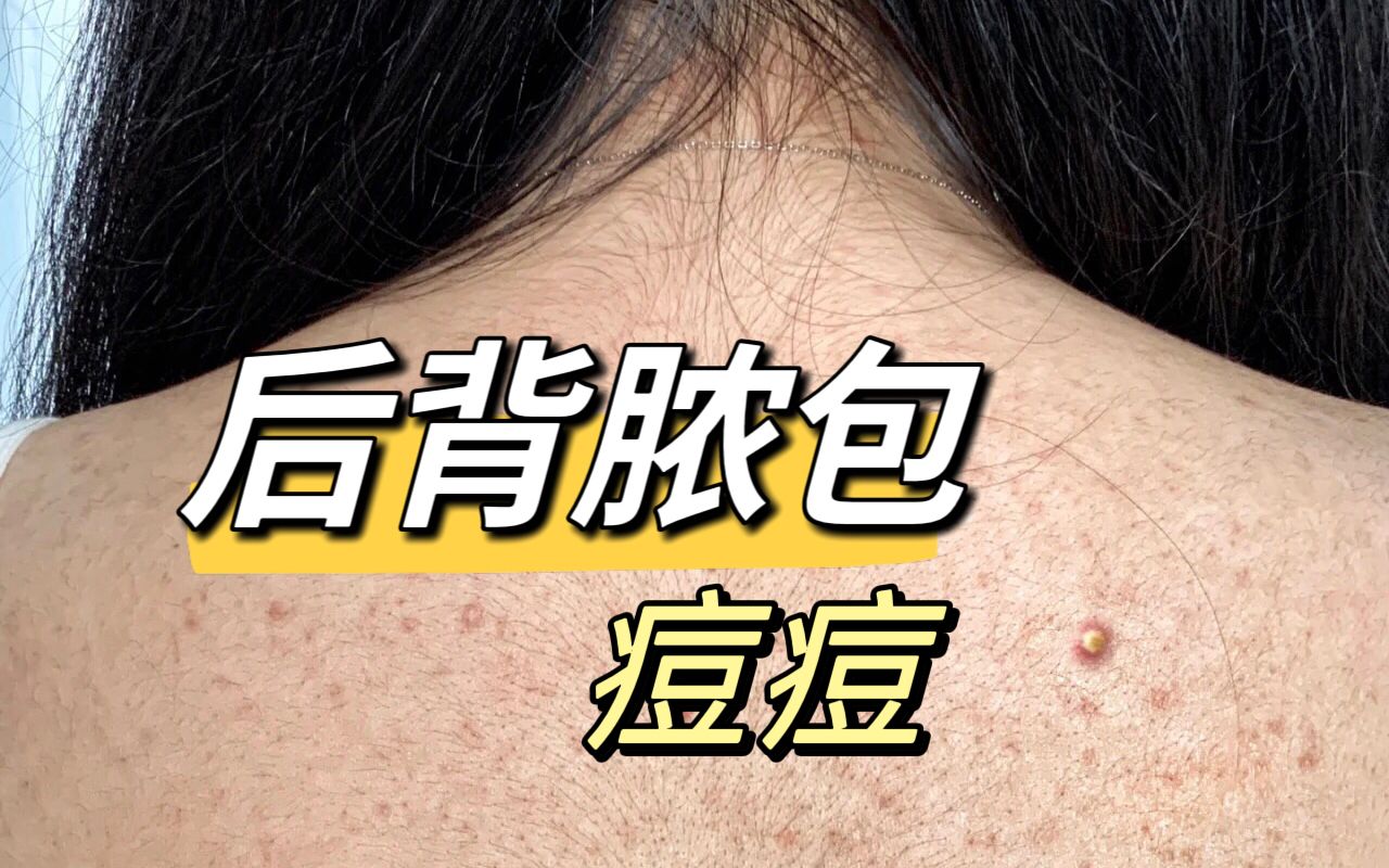 除螨才是祛痘关键!脓包,粉刺洗洗就掉