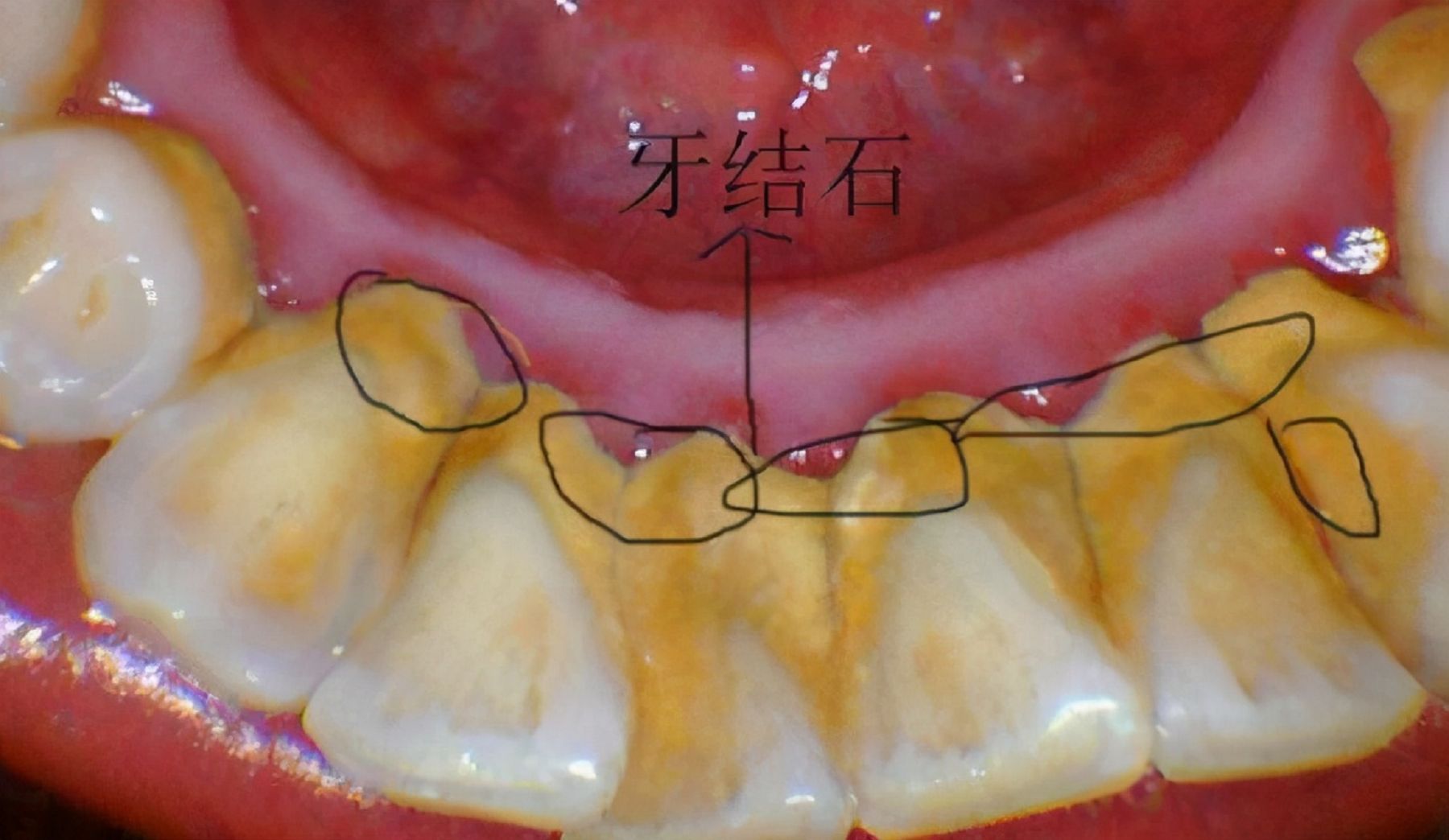 牙结石在家自己怎么去除?用这个方法刷牙,清洁效果超乎想!哔哩哔哩bilibili