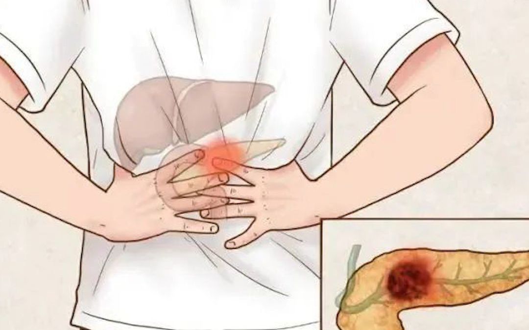 胰腺癌患者平均生存期仅4至6个月
