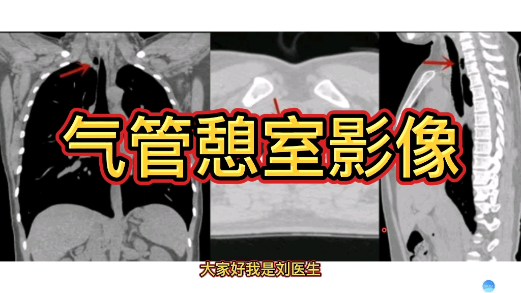 影像报告解读:气管憩室在ct上什么表现?放射科医生讲解!