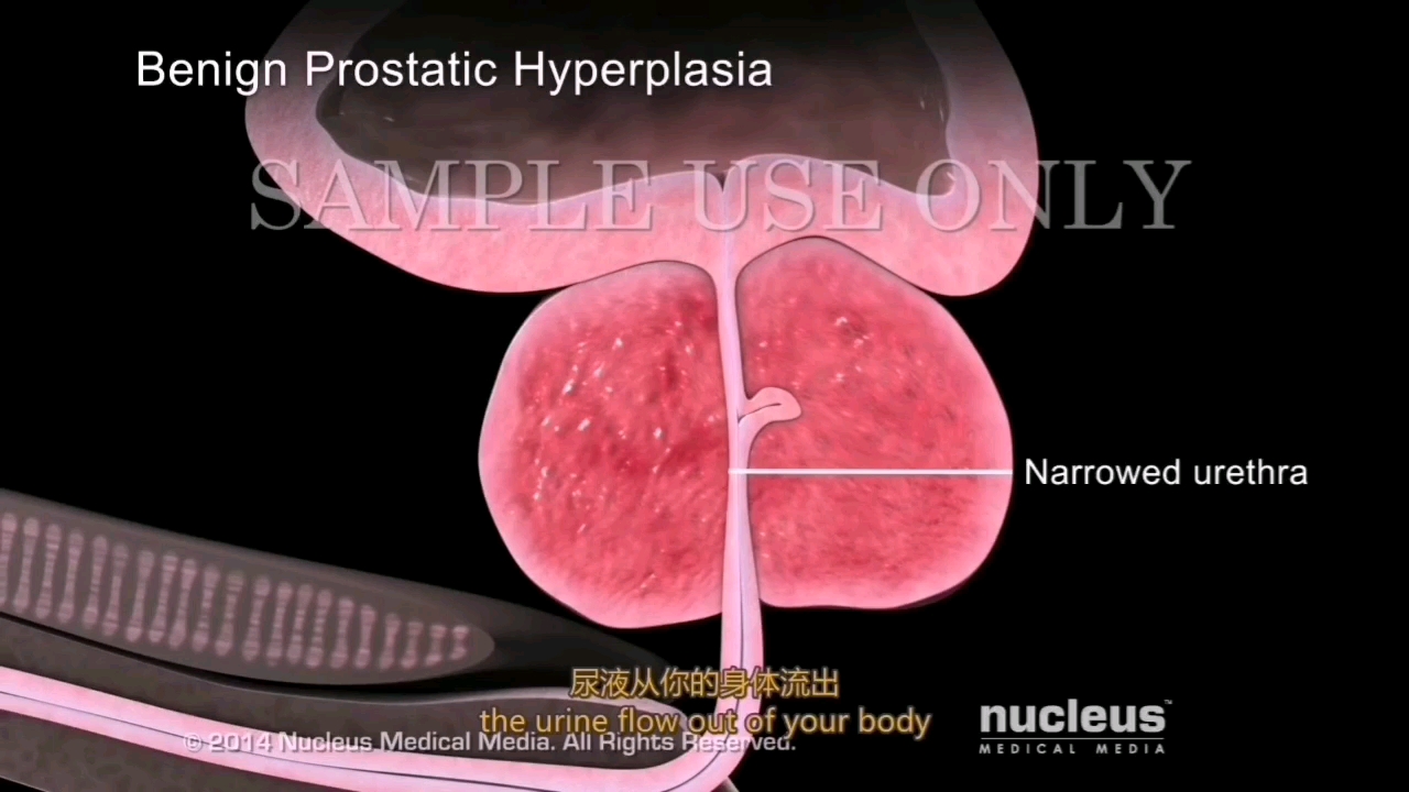 前列腺肥大及治疗(上)哔哩哔哩bilibili