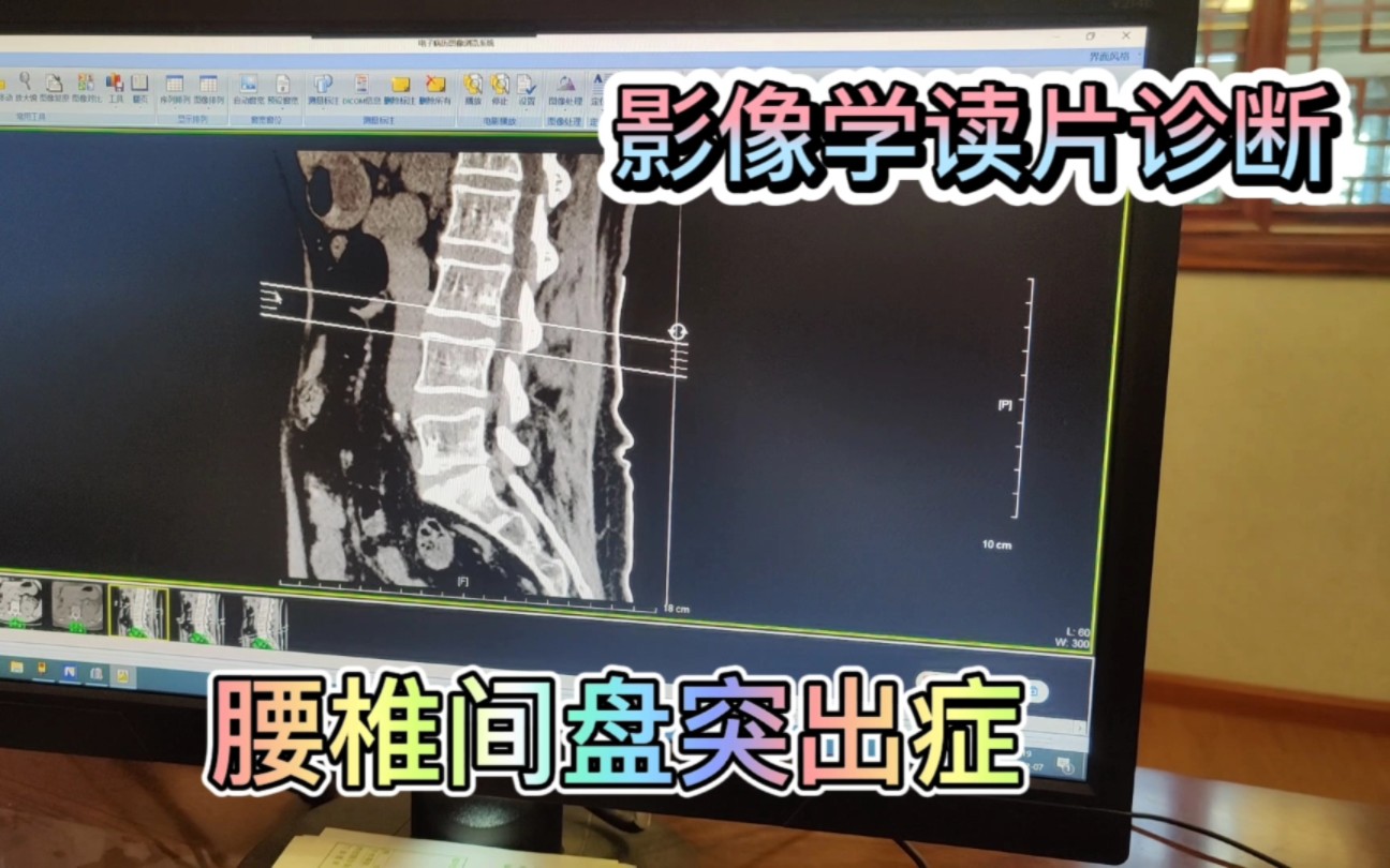 腰椎间盘突出症CT,如何读片诊断?主任医师全方位教学讲解哔哩哔哩bilibili