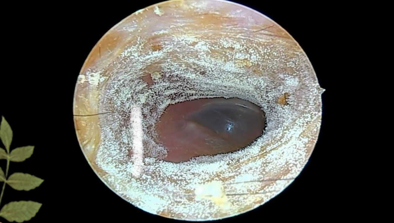 小姐姐耳朵非常不舒服;用采耳工具一看 整个耳道都发霉长毛了!