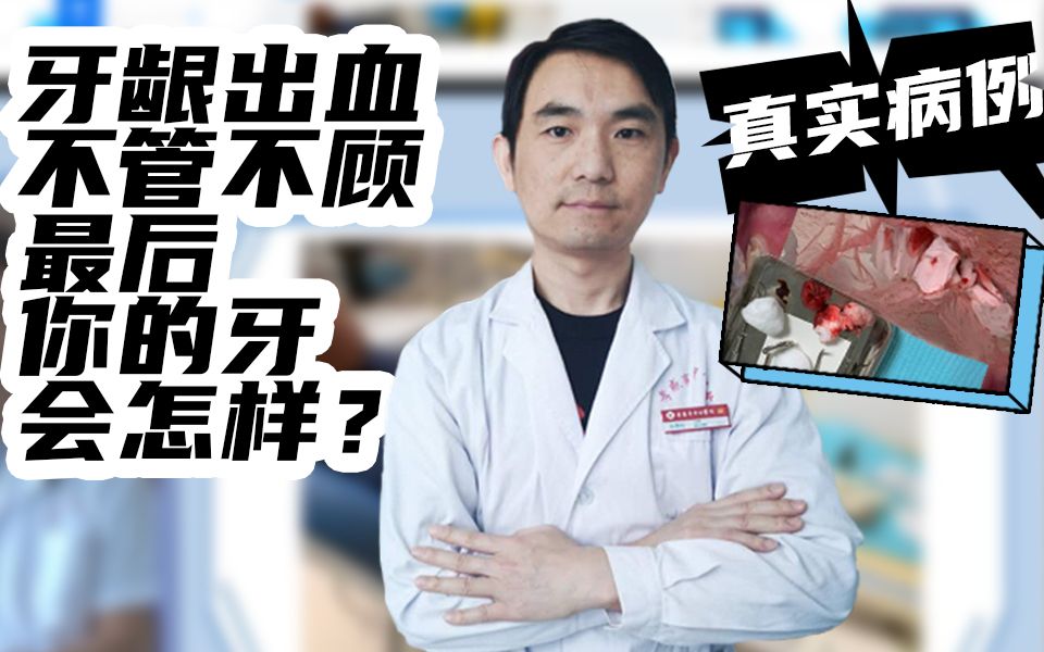 【牙医揭秘】刷牙总出血?止血靠牙膏?一个关于牙龈出血的真相哔哩哔哩bilibili