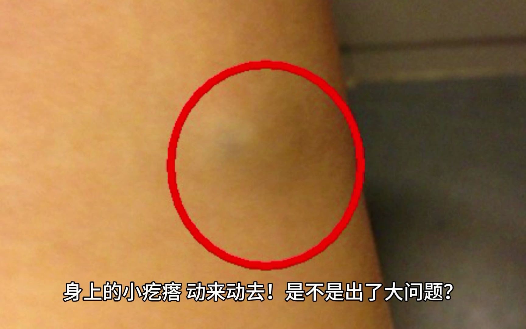 上海可以在皮下活动的小疙瘩,是什么?