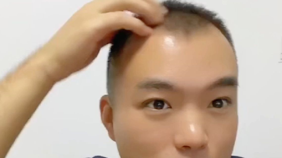 植发多了有点低(植发多了有点低烧怎么办)