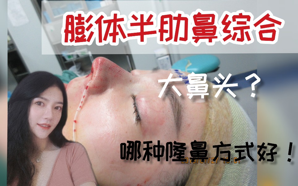 膨体半肋鼻综合隆鼻手术肋骨鼻肋软骨做鼻子vlog案例大鼻头肉鼻翼耳软骨垫鼻子鼻基底缩鼻头鼻整形哔哩哔哩bilibili