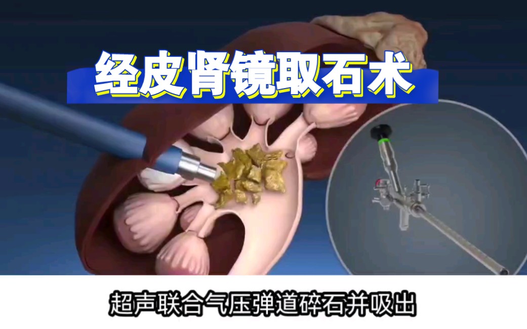 经皮肾镜取石术(PCNL)哔哩哔哩bilibili