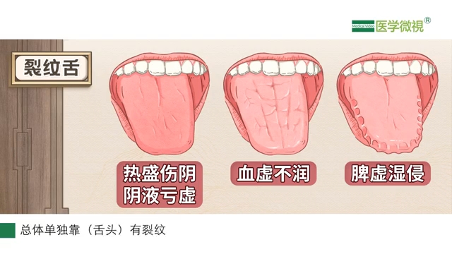 [图]中醫認為舌頭有裂痕是什麼原因？