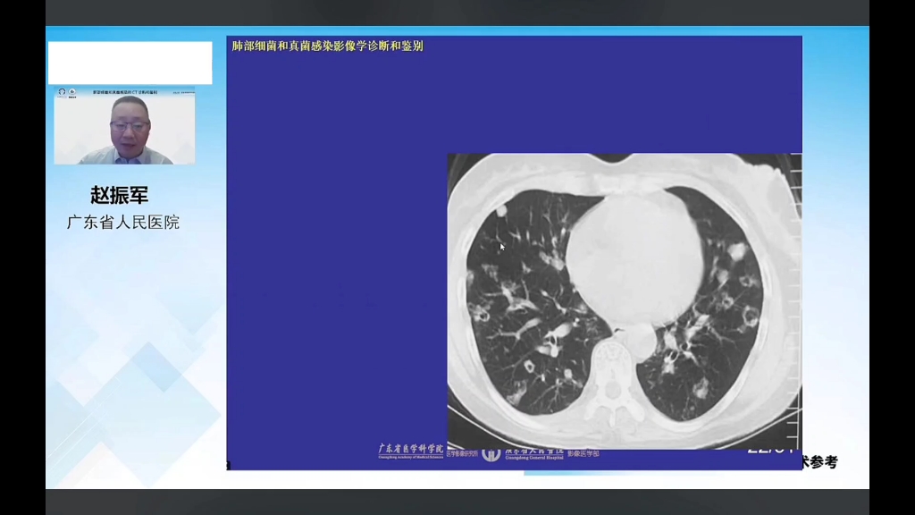 【赵振军教授】肺部细菌和真菌感染的CT诊断和鉴别哔哩哔哩bilibili