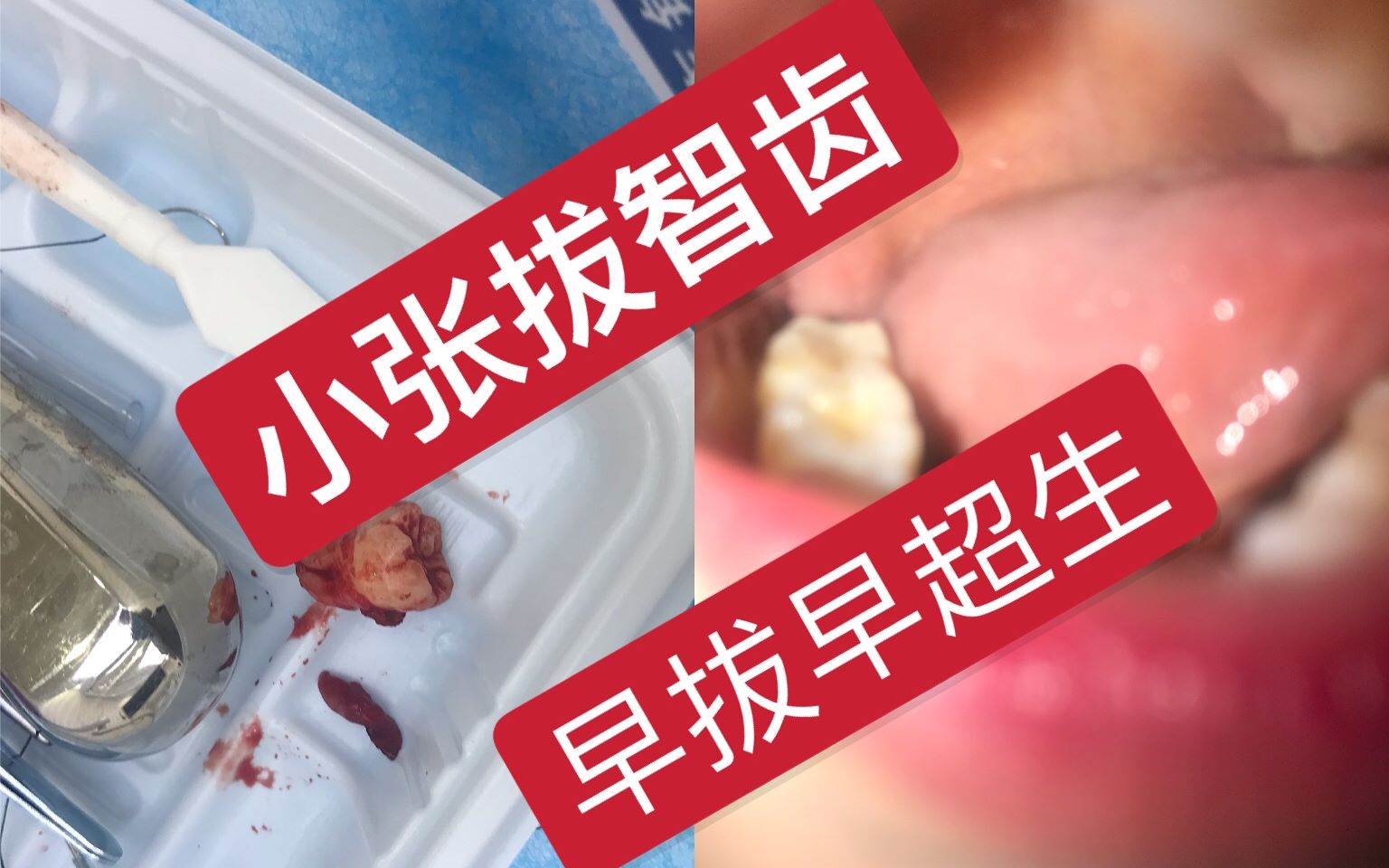 麻醉好疼拔牙好可怕小张智齿拔除一共走了几步