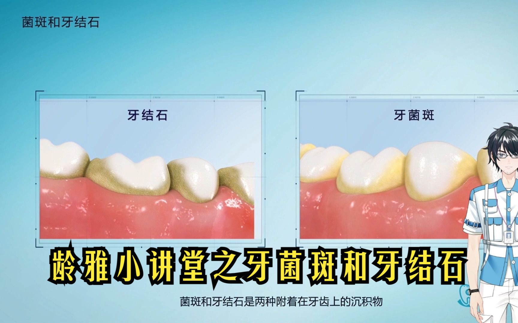 龄雅小讲堂之牙菌斑和牙结石
