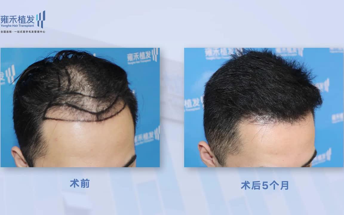 [图]澳門植髮分享！點陣加密無痕植髮頭頂加密3367單位！Yonghe hair transplant