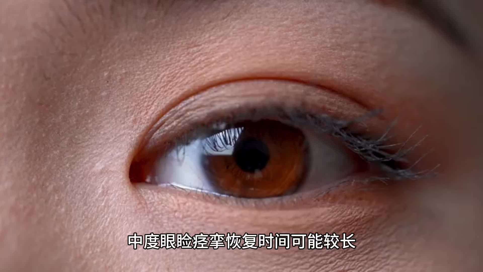 中度眼睑痉挛大概多久恢复