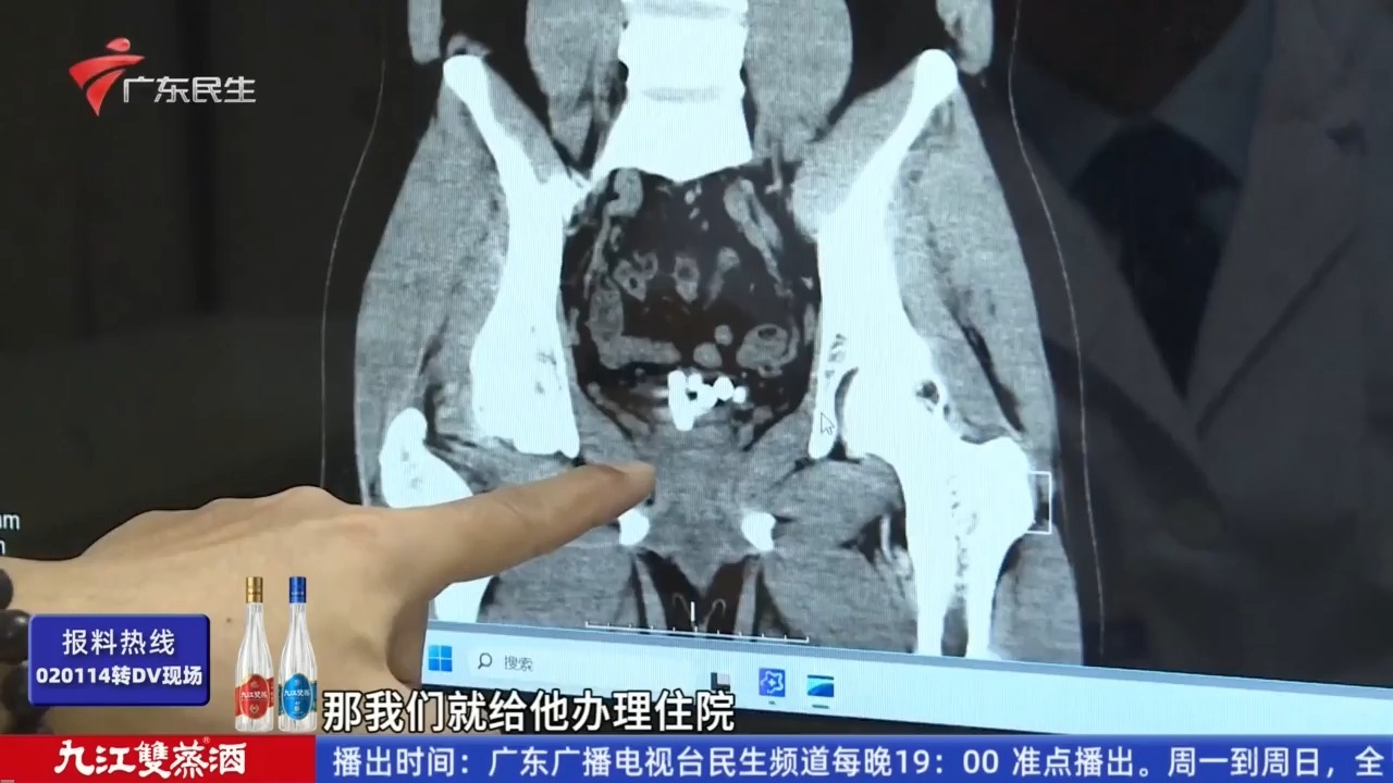 【粤语新闻】广州一男子把一串“珠链”塞入膀胱 医生取出24枚珠子