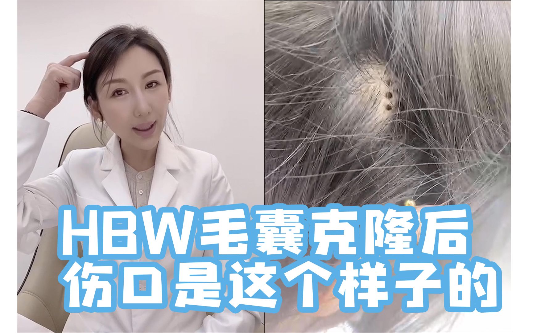 毛囊克隆hbw图片