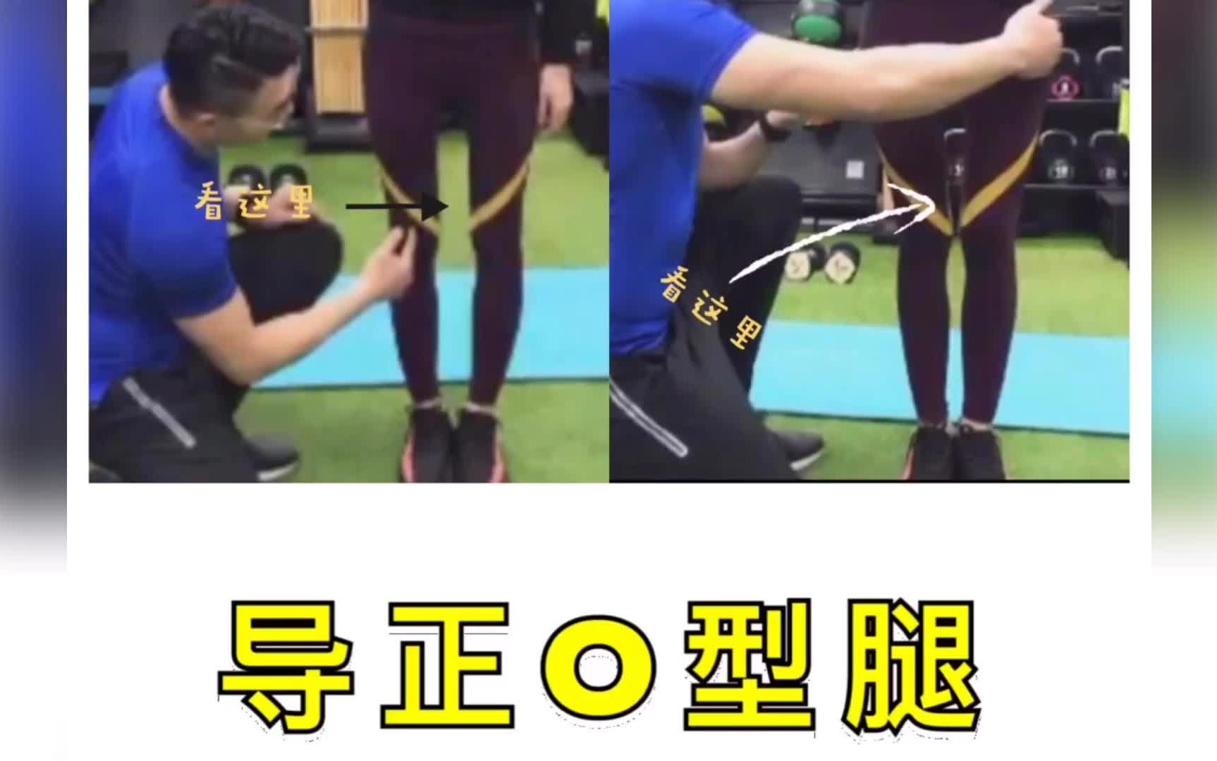 o型腿矫正前后对比