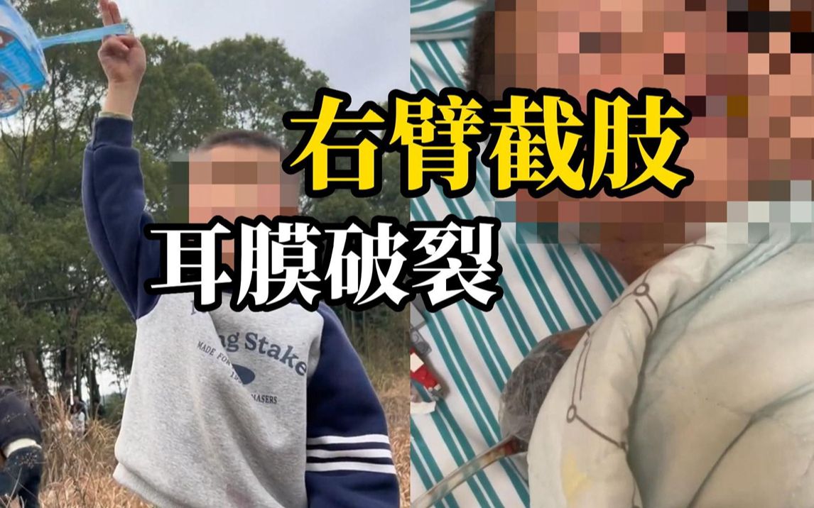 6岁男孩在自己家门口坐着吃橘子,不料竟被邻居家燃放的鞭炮炸伤,导致截肢哔哩哔哩bilibili