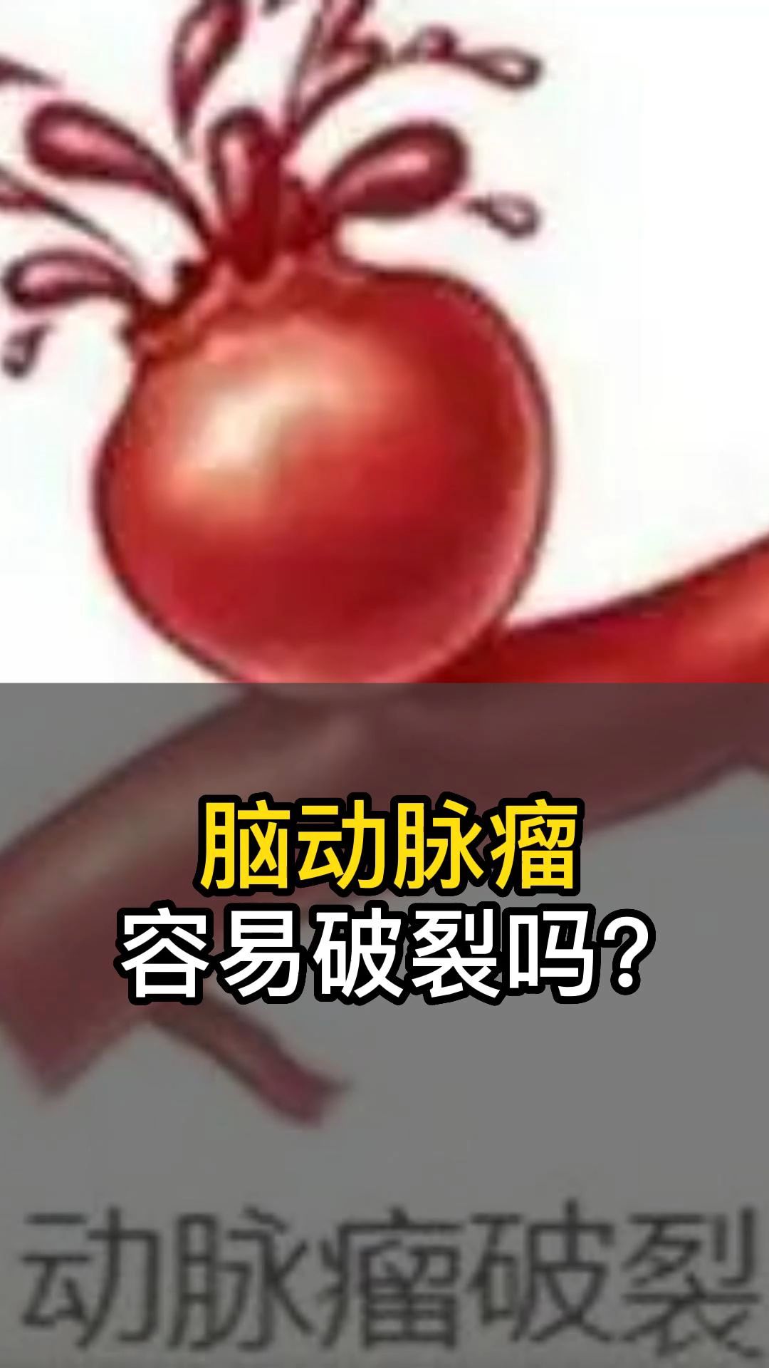 脑动脉瘤容易破裂吗?哔哩哔哩bilibili