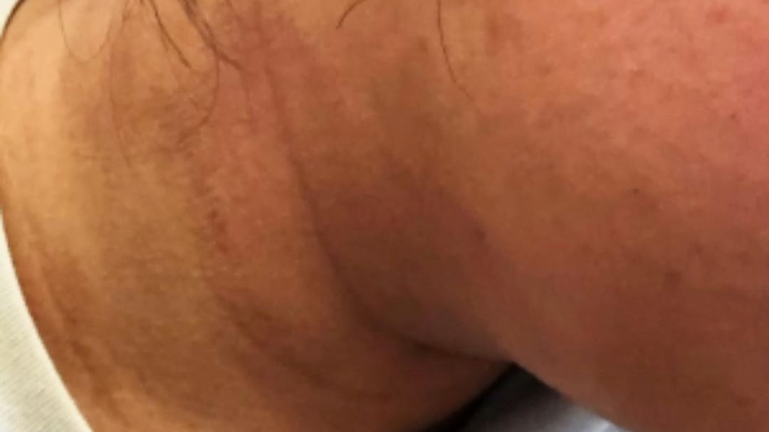 十七岁女生脖子发黑洗不掉 天天喝奶茶竟是罪魁祸首 这信号千万别不当回事