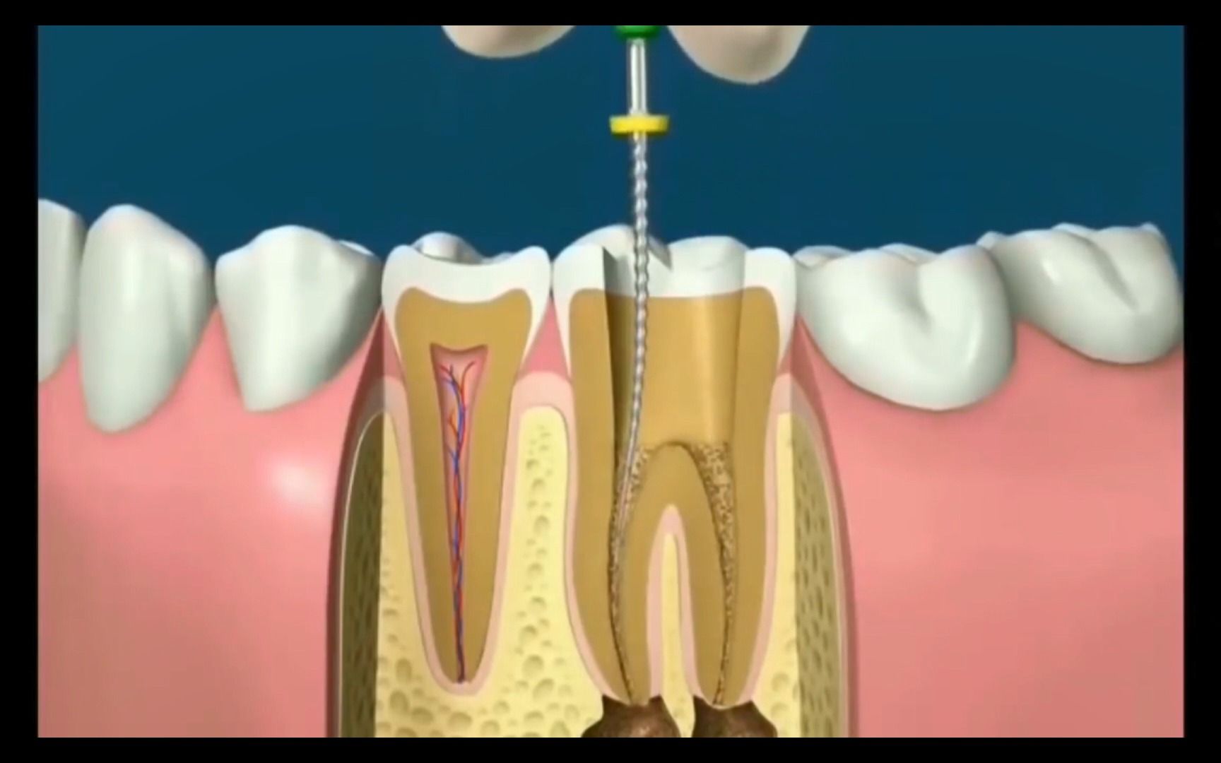 根管治療動畫演示(隔著屏幕就疼系列)