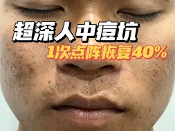 Download Video: 超深人中痘坑，1次点阵恢复40%，怎么做到的？