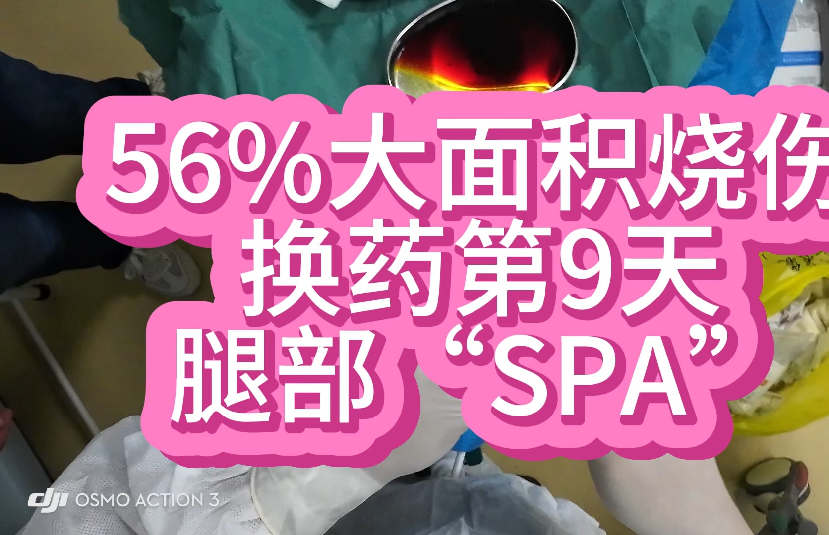 56%大面积烧伤换药第9天,腿部SPA哔哩哔哩bilibili