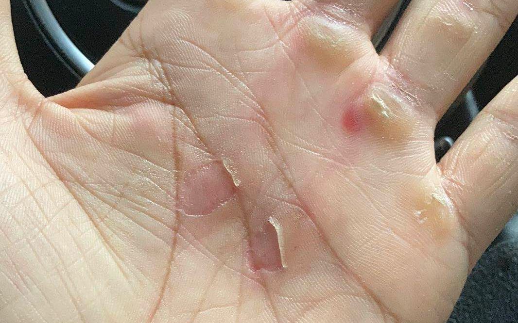 手掌磨破皮是我今天菜鸡的主要理由之一~菜是原罪