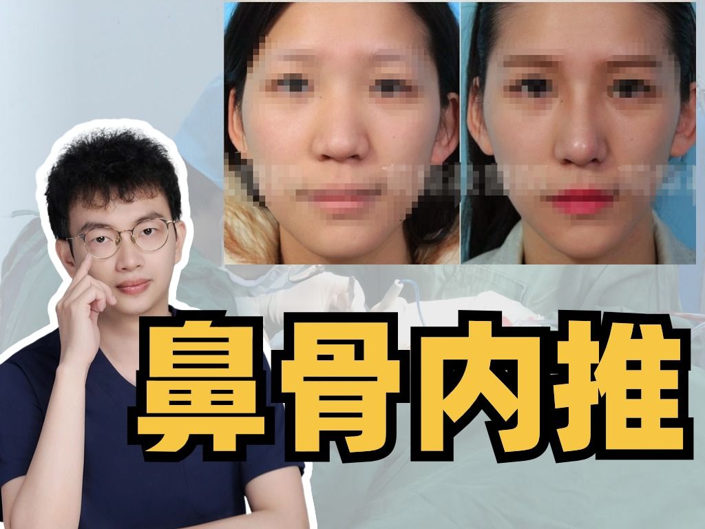 鼻骨内推值得做?