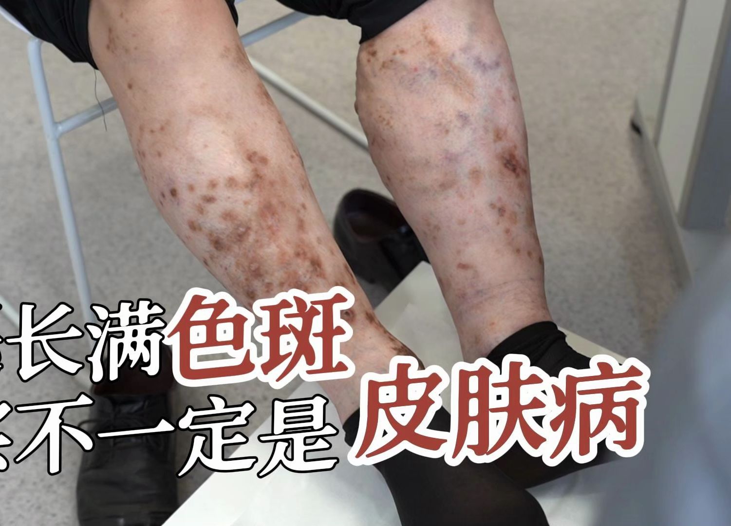 小腿皮肤长满色斑擦药持续不见好,可能是这个原因导致!
