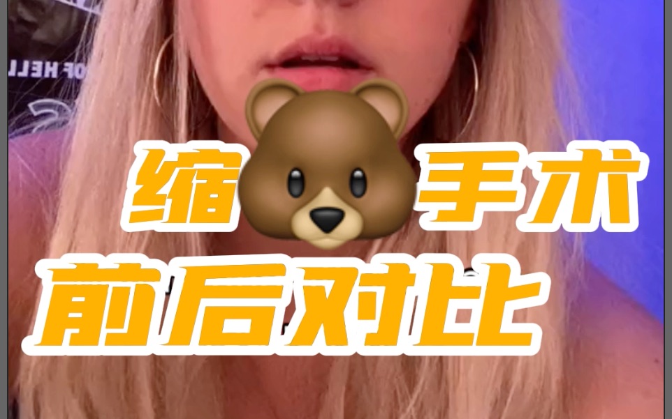 妹子分享缩胸手术的心路历程和前后对比....哔哩哔哩bilibili