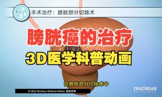 Download Video: 膀胱癌的几种治疗方法，3D科普动画（nucleus医学科普视频系列）中文