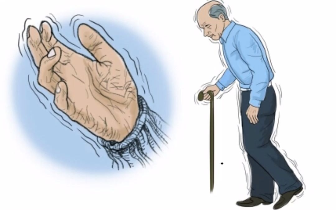 延髓麻痹型运动神经元病典型症状