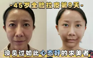 Download Video: 45岁全脸拉皮第9天，没见过如此心态好的，是年轻了啊！