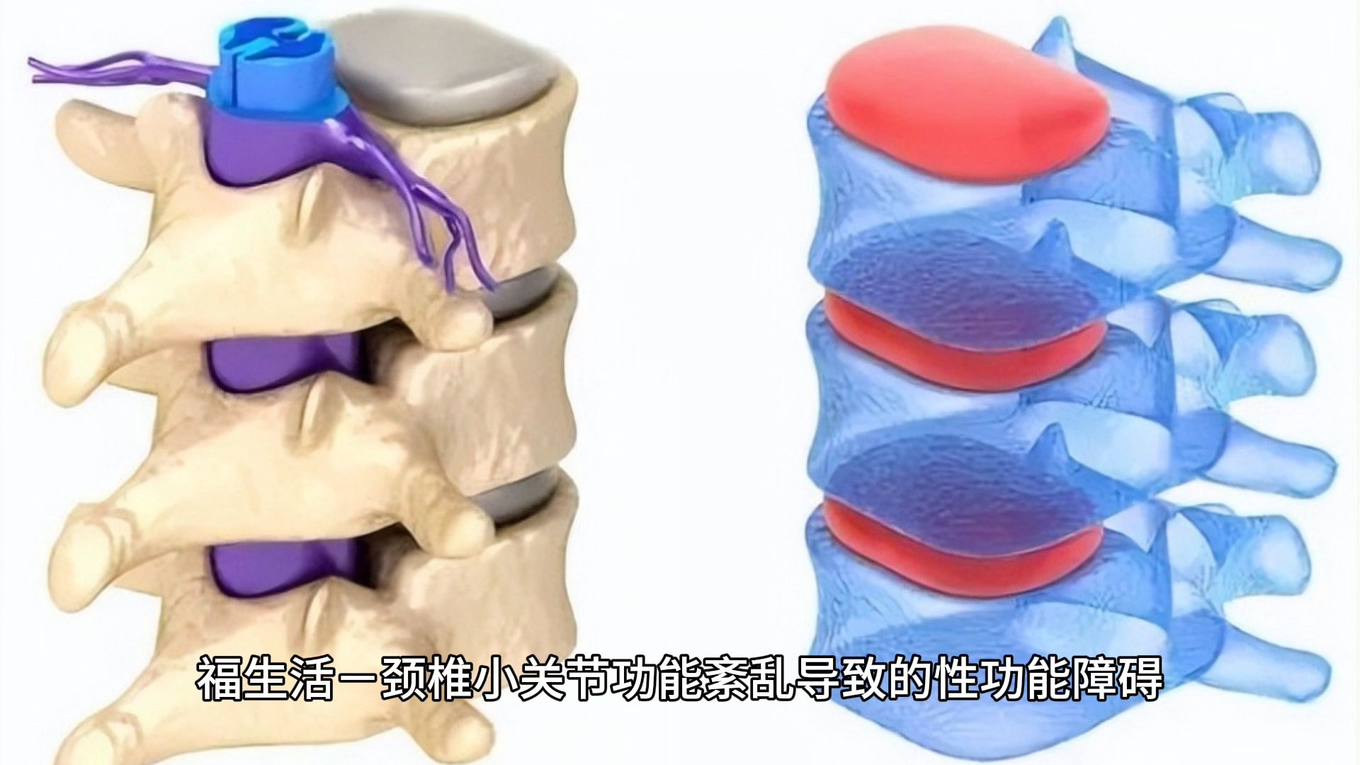 椎小关节骨质增生图片