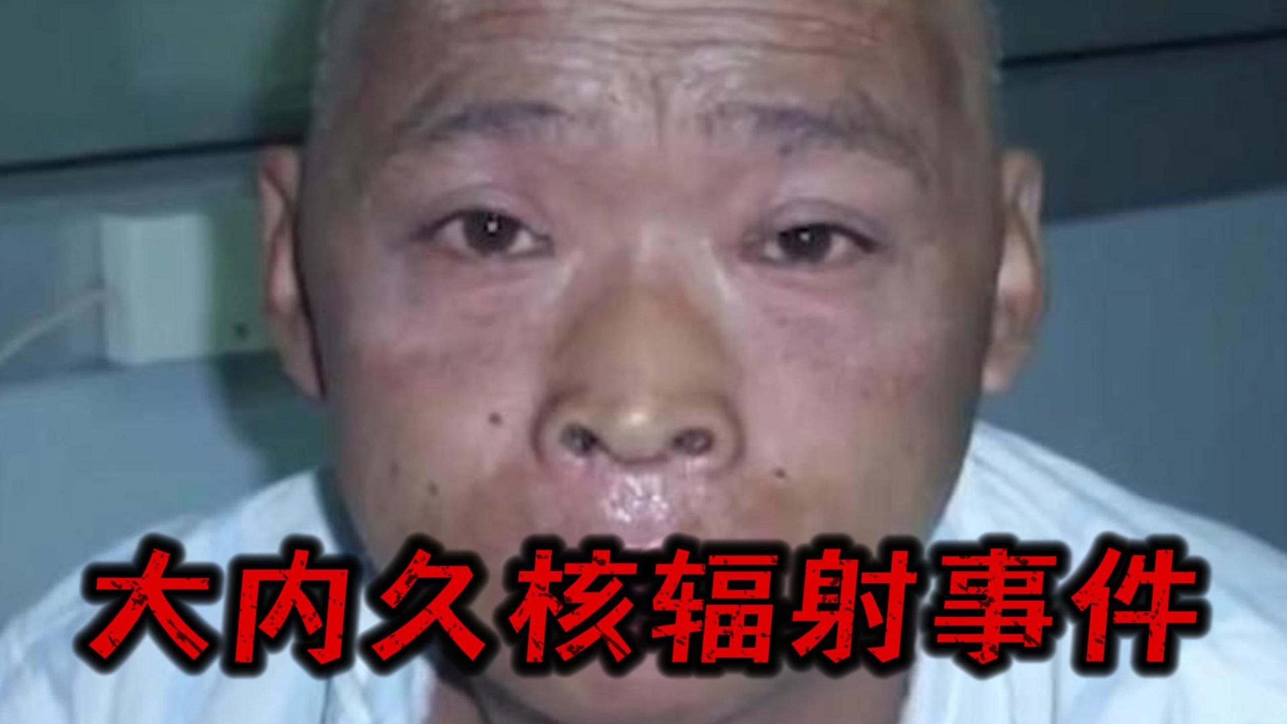 《日本大内久核辐射事件》